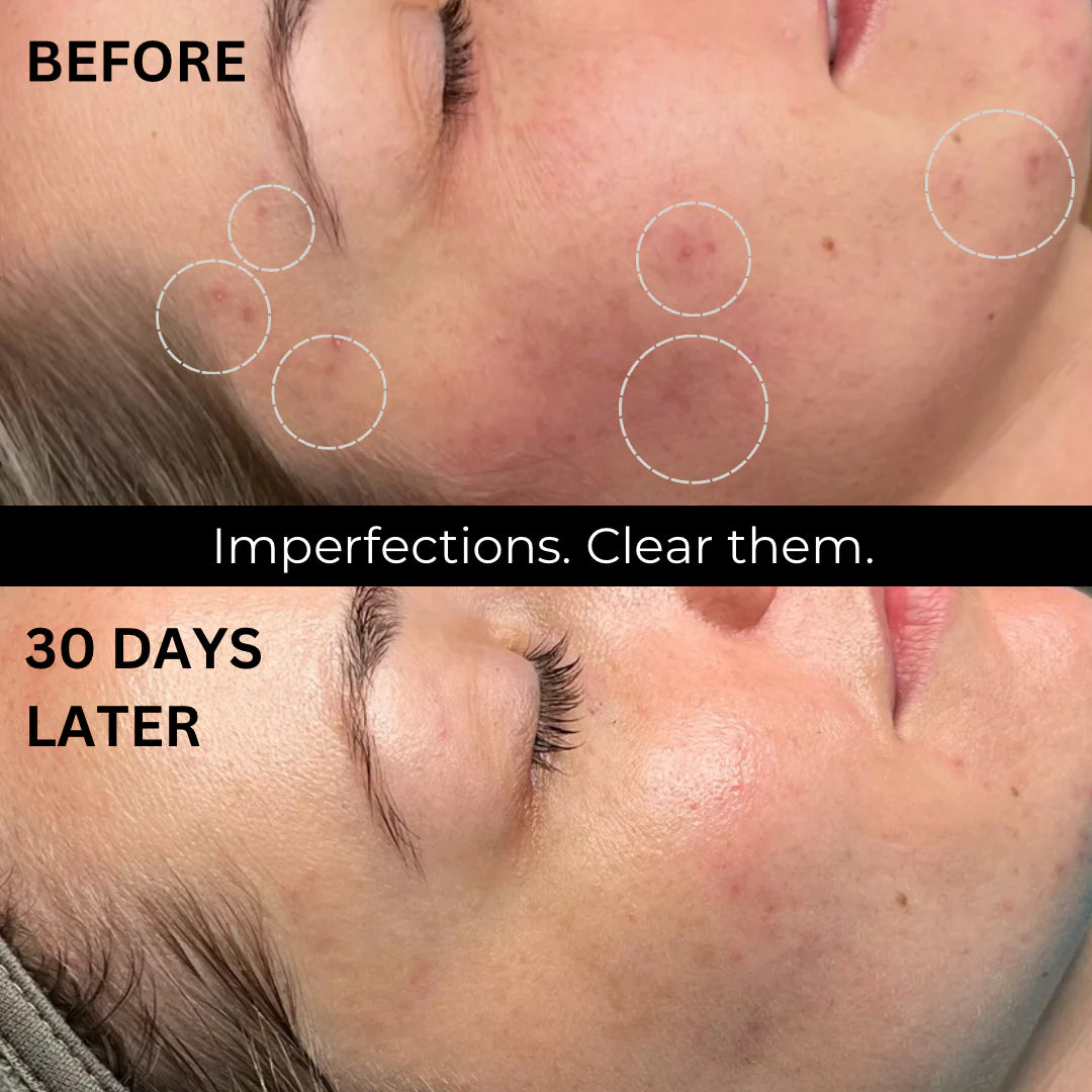 Retinal + Azelaic Powder Serum 25g – Anti-Aging & Acne Treatment | Rejuvenece, aclara y combate el acné